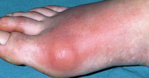Kisah Benar ! Sakit Gout Umpama Ditusuk Jarum