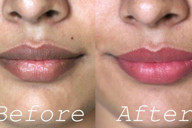Inilah 5 Cara Berkesan Cerahkan Bibir Hitam Secara Semulajadi