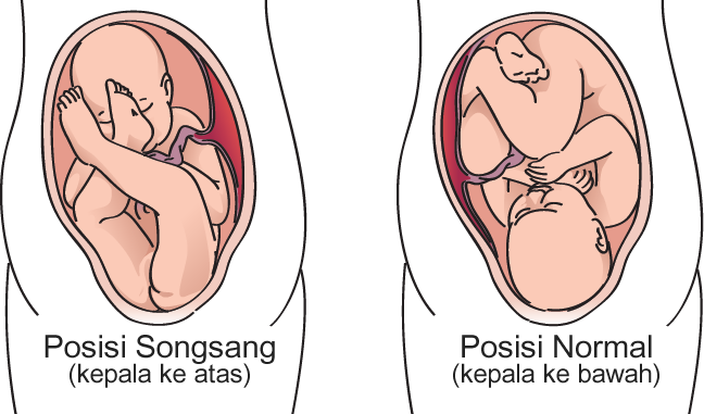 Kalau Doktor Sahkan Bayi Songsang & Tali Pusat Terbelit,5 Perkara Ini Patut Dilakukan!