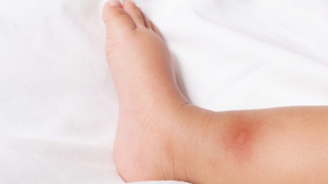 7 Petua Berkesan Hilangkan Kesan Gigitan Nyamuk Pada Bayi