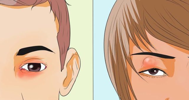 8 Petua Berkesan Menghilangkan Ketumbit Dengan Cepat