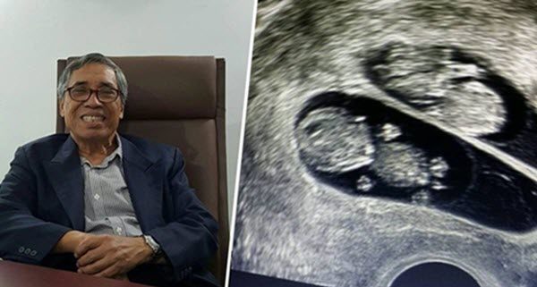 Doktor Ini Kongsi 8 Cara Berpeluang Untuk Dapat Anak Kembar