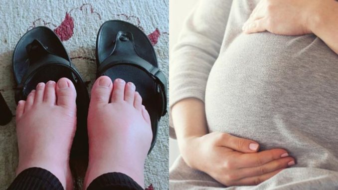 Doktor Ini Kongsikan Tip Untuk Kurangkan Bengkak Pada Kaki Ibu Hamil