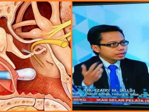 Ramai Yang Tak Tahu Sebenarnya Tahi Telinga Tidak Perlu Dibuang Kerana Banyak Fungsinya…