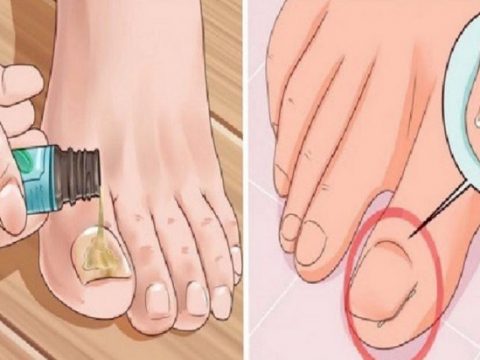 Ambik Tahu Punca Dan 8 Cara Mudah Merawat Cagu Pada Kuku Kaki, Jangan Biarkan Kuku Anda Rosak